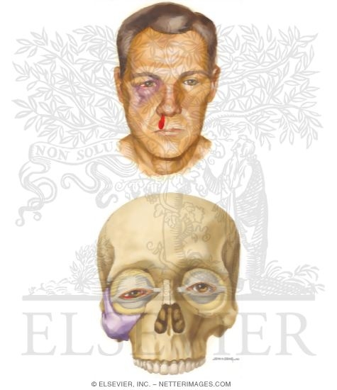 Zygomatic Fractures