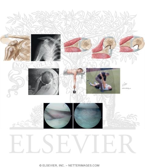 Watermarked preview of unlabeled image: Anterior Glenohumeral Instability