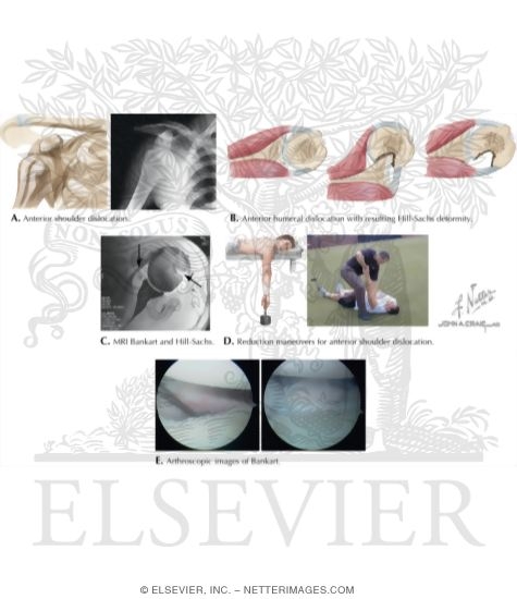 Watermarked preview of labeled image: Anterior Glenohumeral Instability