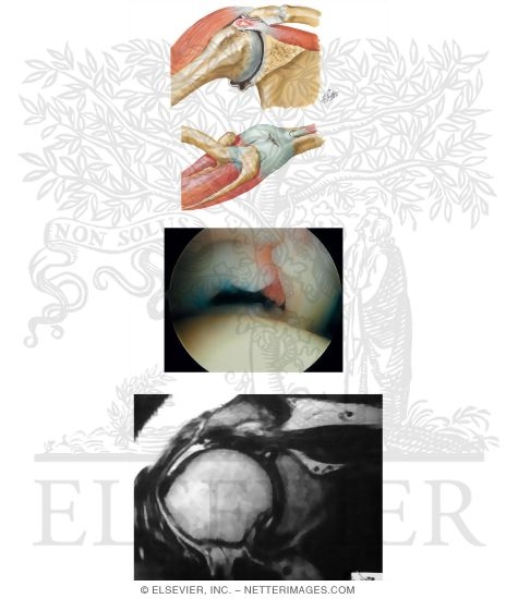 Watermarked preview of unlabeled image: Rotator Cuff Injury