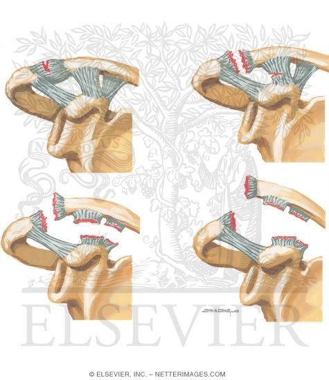 Watermarked preview of unlabeled image: Acromioclavicular Dislocation