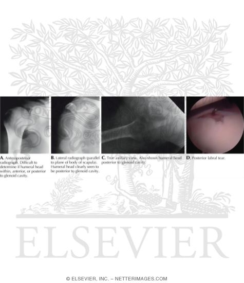 Watermarked preview of labeled image: Posterior Glenohumeral Instability