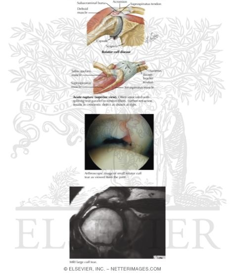 Watermarked preview of labeled image: Rotator Cuff Injury