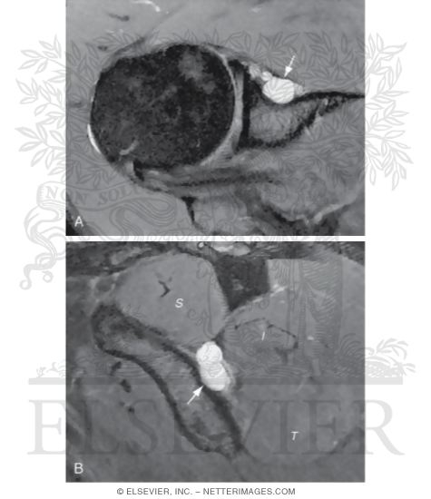 Watermarked preview of labeled image: Spinoglenoid Cyst