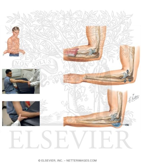 Tennis Elbow