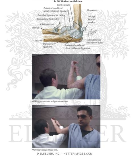 Watermarked preview of labeled image: Ulnar Collateral Ligament Sprain