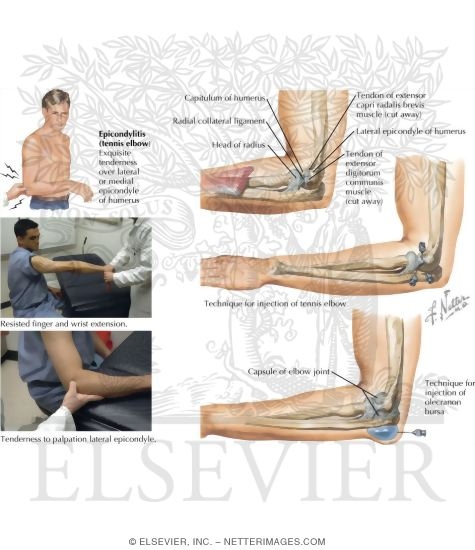 Watermarked preview of labeled image: Tennis Elbow