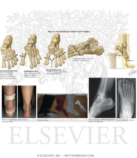 Watermarked preview of labeled image: Injury to Tarsometatarsal (Lisfranc) Joint Complex