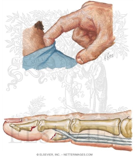 Jersey Finger