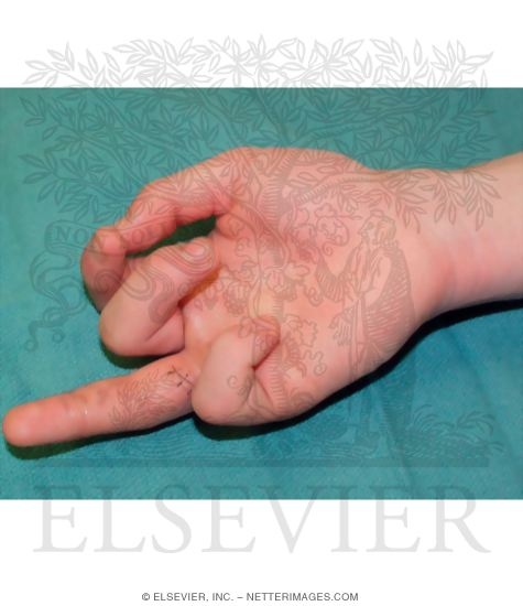 Flexor Tendon Laceration