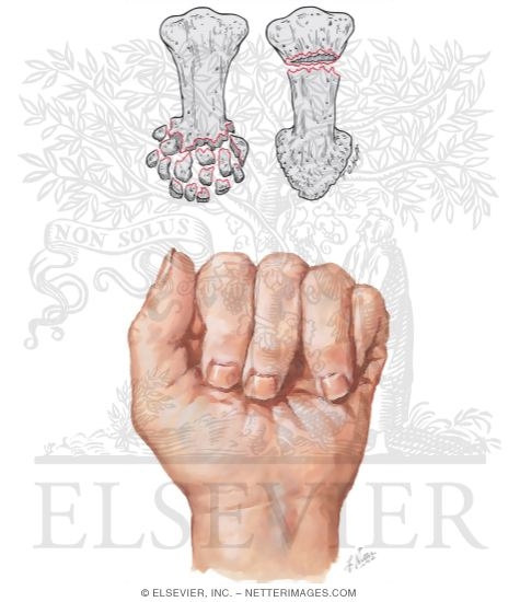 Watermarked preview of unlabeled image: Phalangeal Fractures