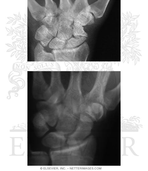 Watermarked preview of unlabeled image: Scaphoid Fractures