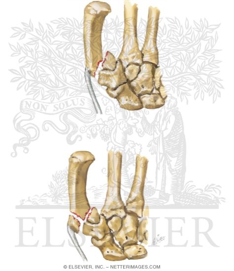 Bennett's and Rolando's (First MC Base) Fractures