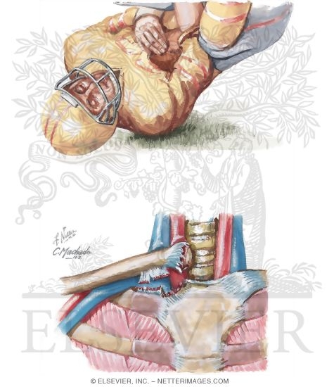 Watermarked preview of unlabeled image: Posterior Dislocation of Sternoclavicular Joint
