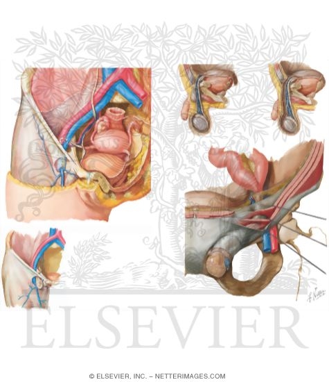 Watermarked preview of unlabeled image: Hernias