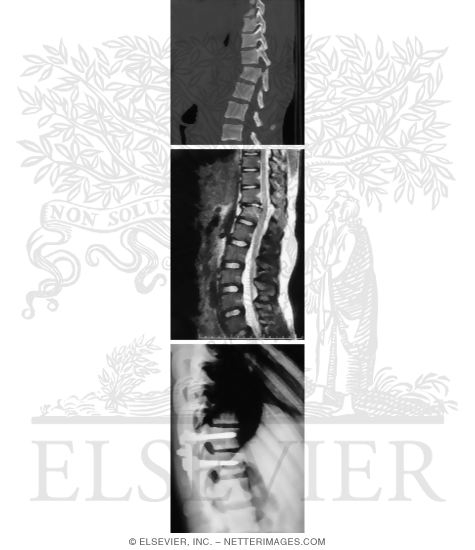 Fracture Dislocation of T11 On T12