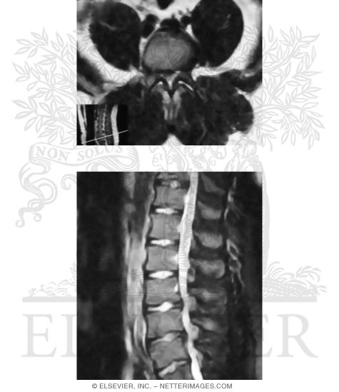 Watermarked preview of unlabeled image: Spinal Stenosis