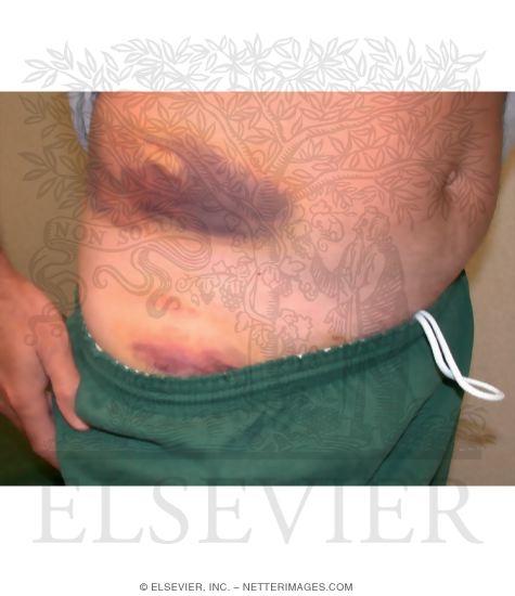 Iliac Crest Contusion