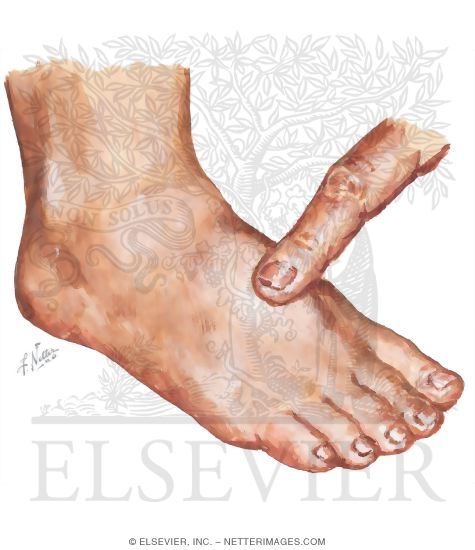 Watermarked preview of unlabeled image: Physical Examination of Stress Fracture