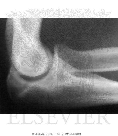 Watermarked preview of unlabeled image: Lateral Elbow, Olecranon Stress Fracture