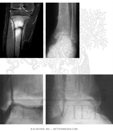 Knee and Lower Leg Stress Fractures