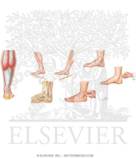Watermarked preview of unlabeled image: Achilles Tendinitis and Retrocalcaneal Bursitis