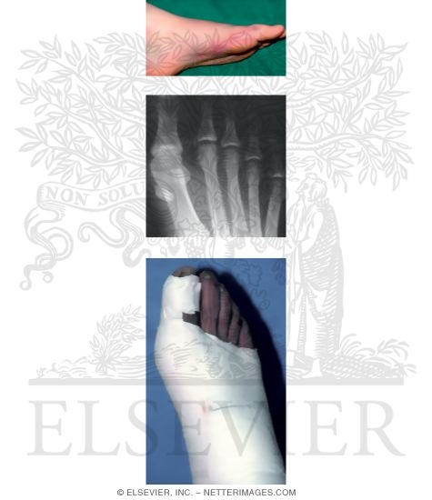 Watermarked preview of unlabeled image: Turf Toe