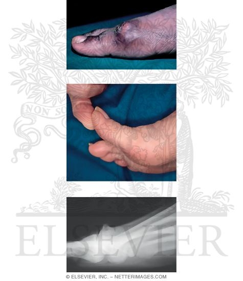 Hallux Rigidus