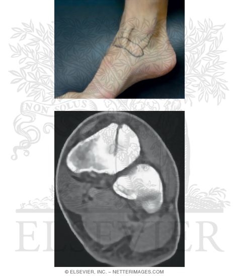 Navicular Stress Fracture