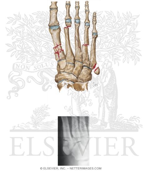 Metatarsal Fractures