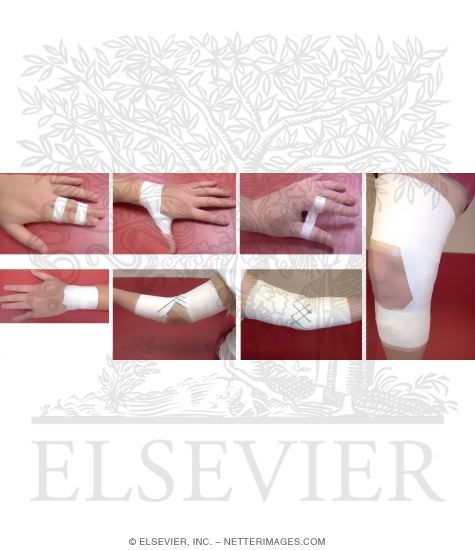 Various Taping Procedures