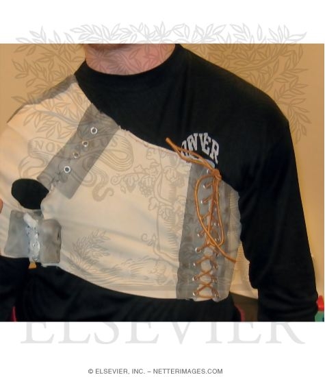 Anterior Shoulder Instability