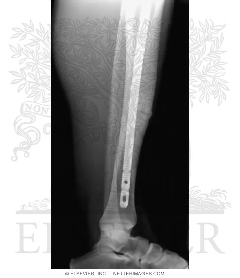 Watermarked preview of unlabeled image: Recalcitrant Anterior Tibial Stress Fracture