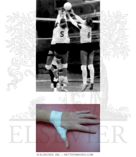 Watermarked preview of unlabeled image: Finger and Thumb Sprains