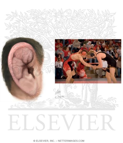 Watermarked preview of unlabeled image: Auricular Hematoma (
