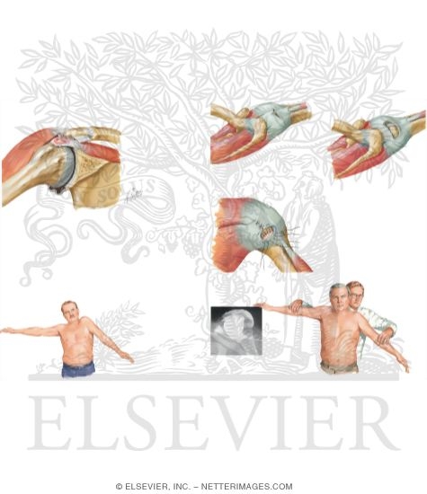 Watermarked preview of unlabeled image: Rotator Cuff Injuries