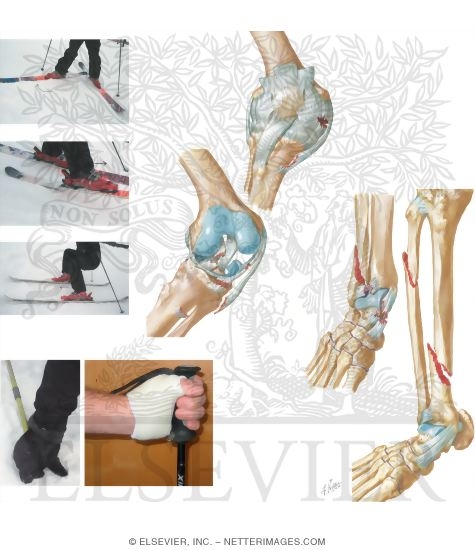 Watermarked preview of unlabeled image: Skiing Injuries