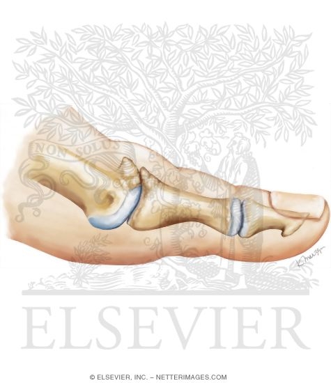Skier's Toe
