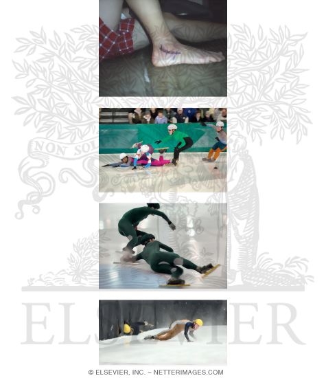 Watermarked preview of unlabeled image: Speed Skating Injuries