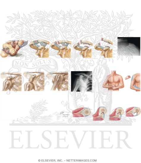 Watermarked preview of unlabeled image: Shoulder Injuries In Lacrosse