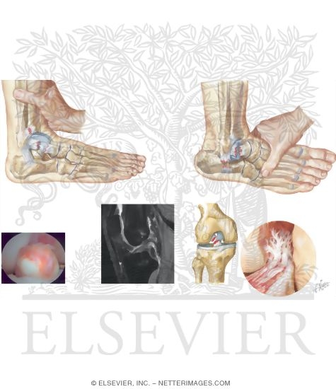 Watermarked preview of unlabeled image: Lower Extremity Injuries In Lacrosse