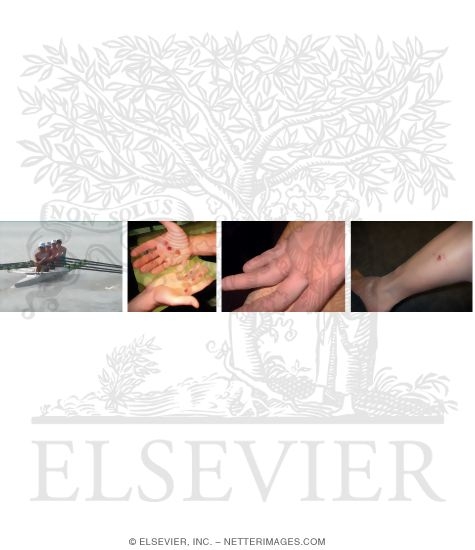 Hand Blisters and Skin Abrasions In Rowing