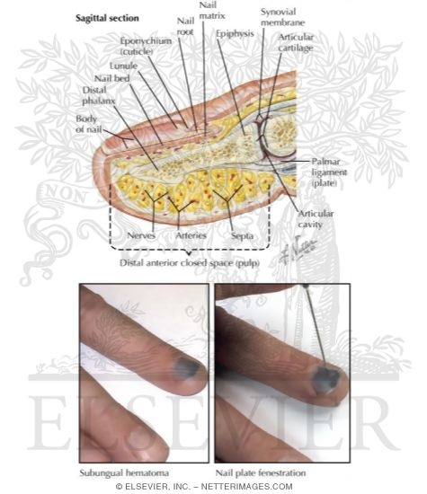 Nail Bed Injury
