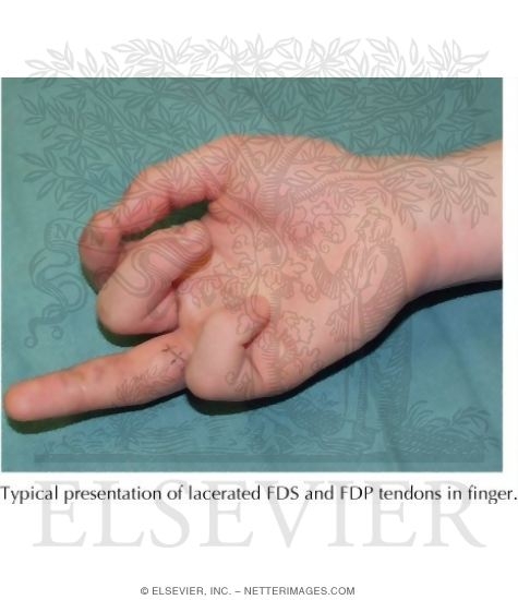 Flexor Tendon Laceration