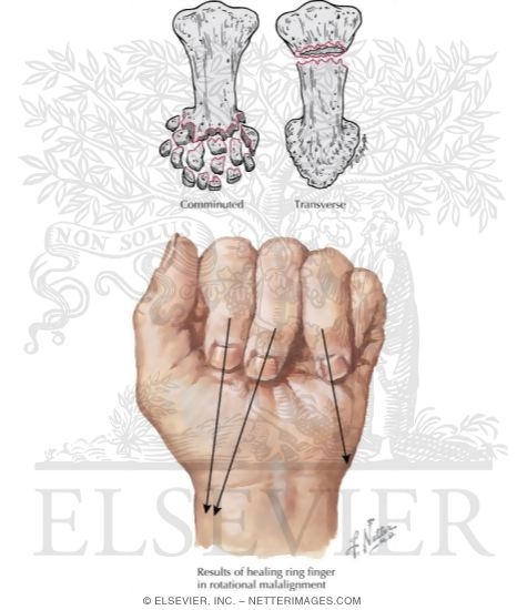 Watermarked preview of labeled image: Phalangeal Fractures