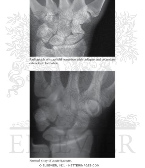 Watermarked preview of labeled image: Scaphoid Fractures