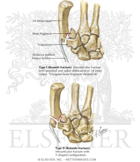 Bennett's and Rolando's (First MC Base) Fractures