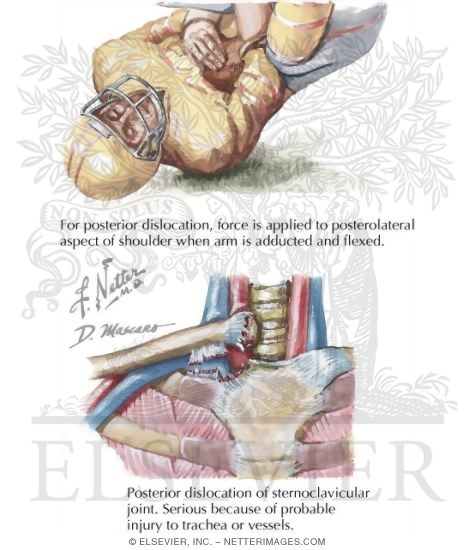 Watermarked preview of labeled image: Posterior Dislocation of Sternoclavicular Joint