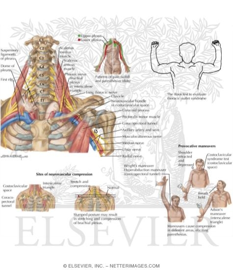 Watermarked preview of labeled image: Thoracic Outlet Syndrome