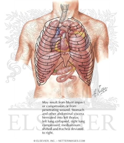 Rupture of Diaphragm